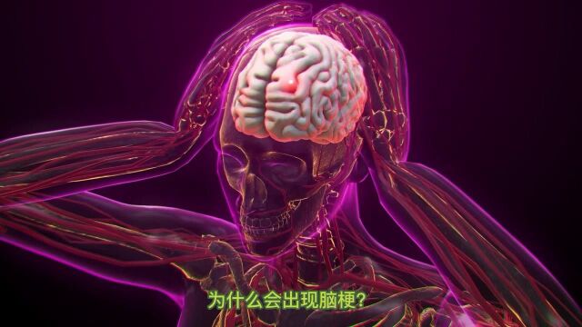 脑梗怎么办?6个方法,或许能让脑梗“看不到”你