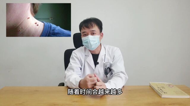 脖子上长了很多丝状的“小肉丁”,这种是丝状疣,教你一招解决