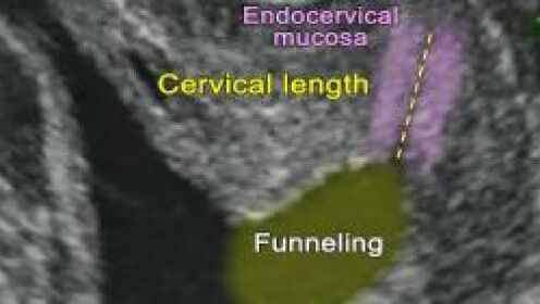 short cervix