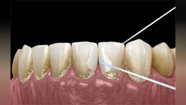 国货牙粉真的有效!去除牙结石只需做到这几步,每天一次就能去牙石!