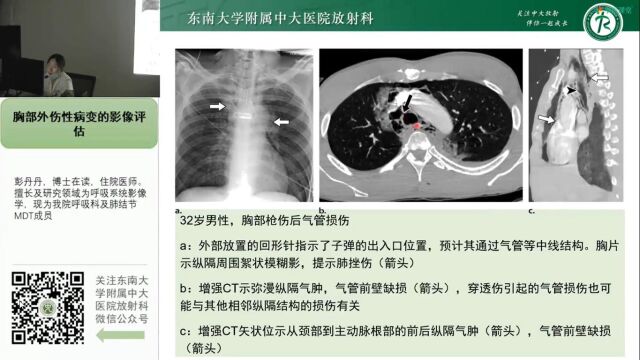 胸部外伤的影像学表现中大彭丹丹