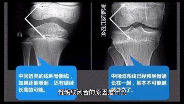 骨骺线闭合的原因是什么