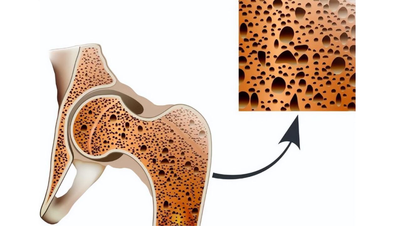 骨质疏松"元凶"被揪出,2件事不改,加速钙流失,骨骼未老先衰