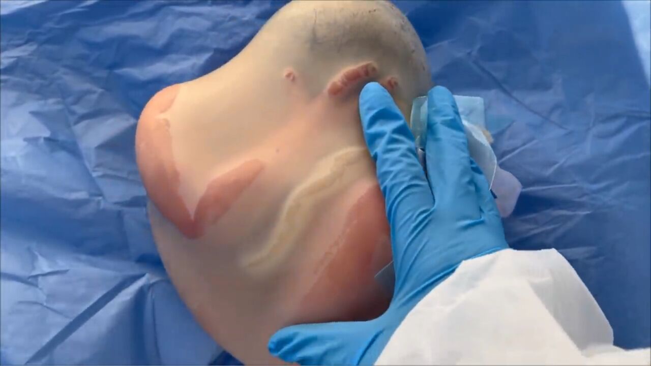 刚刚出生还被羊膜包裹的婴儿,医生护士爱不释手