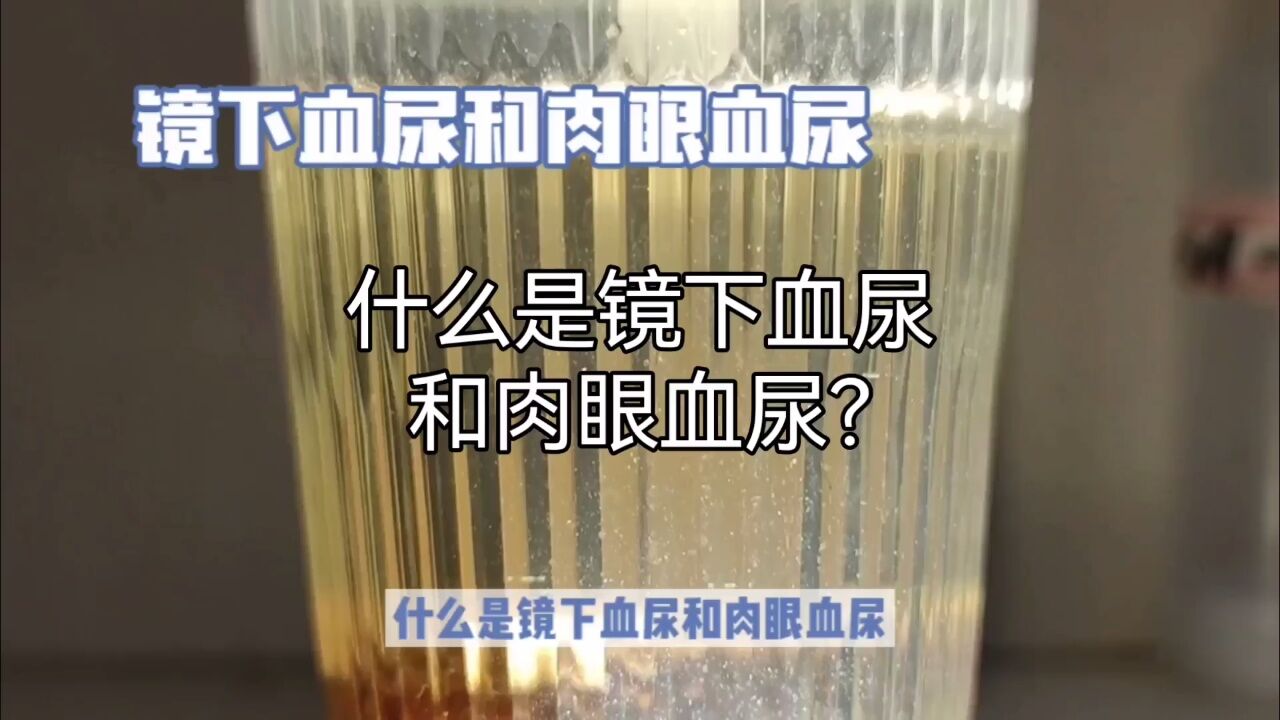 什麼是鏡下血尿和肉眼血尿?