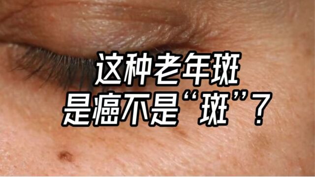 人老了长老年斑很正常?提醒:一种“老年斑”是癌不是斑