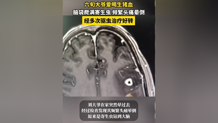 7月4日(发布时间),广东深圳,六旬大爷爱喝生猪血,脑袋爬满寄生虫 频繁