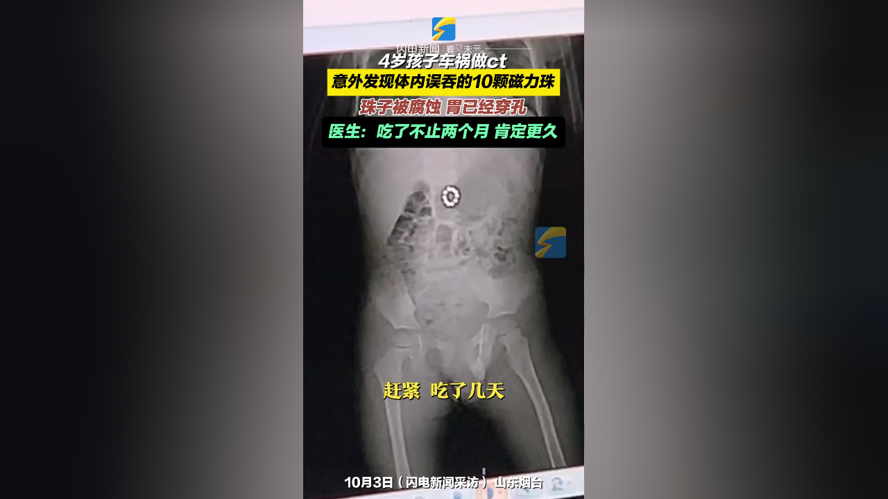 孩子吃了磁力珠排出来了怎么办=小孩把磁力珠吃到肚子里有什么症状