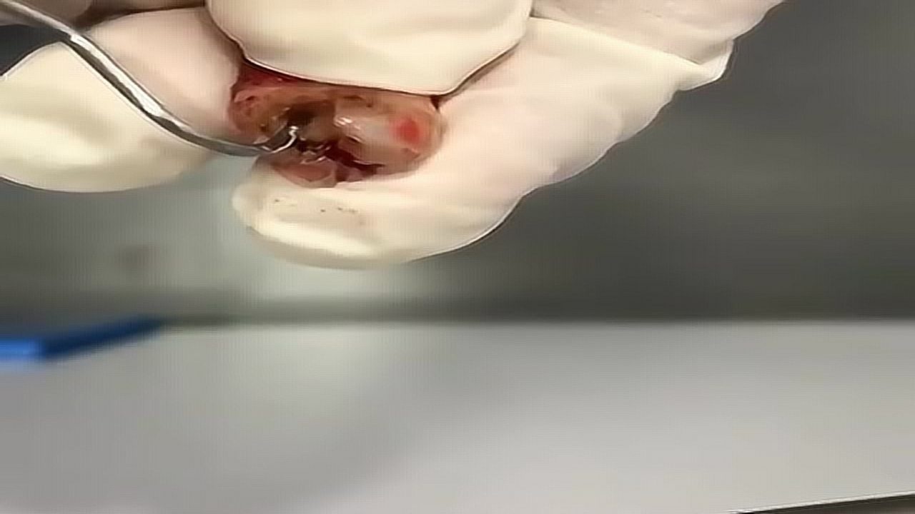 牙医实拍拔掉的蛀牙：黑乎乎地一戳一个洞_高清