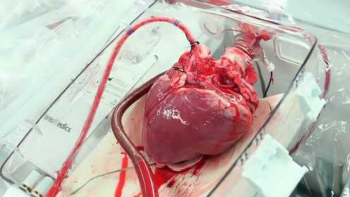 全球首例3D打印心脏，像真心脏一样跳动，造福千万心脏病患者