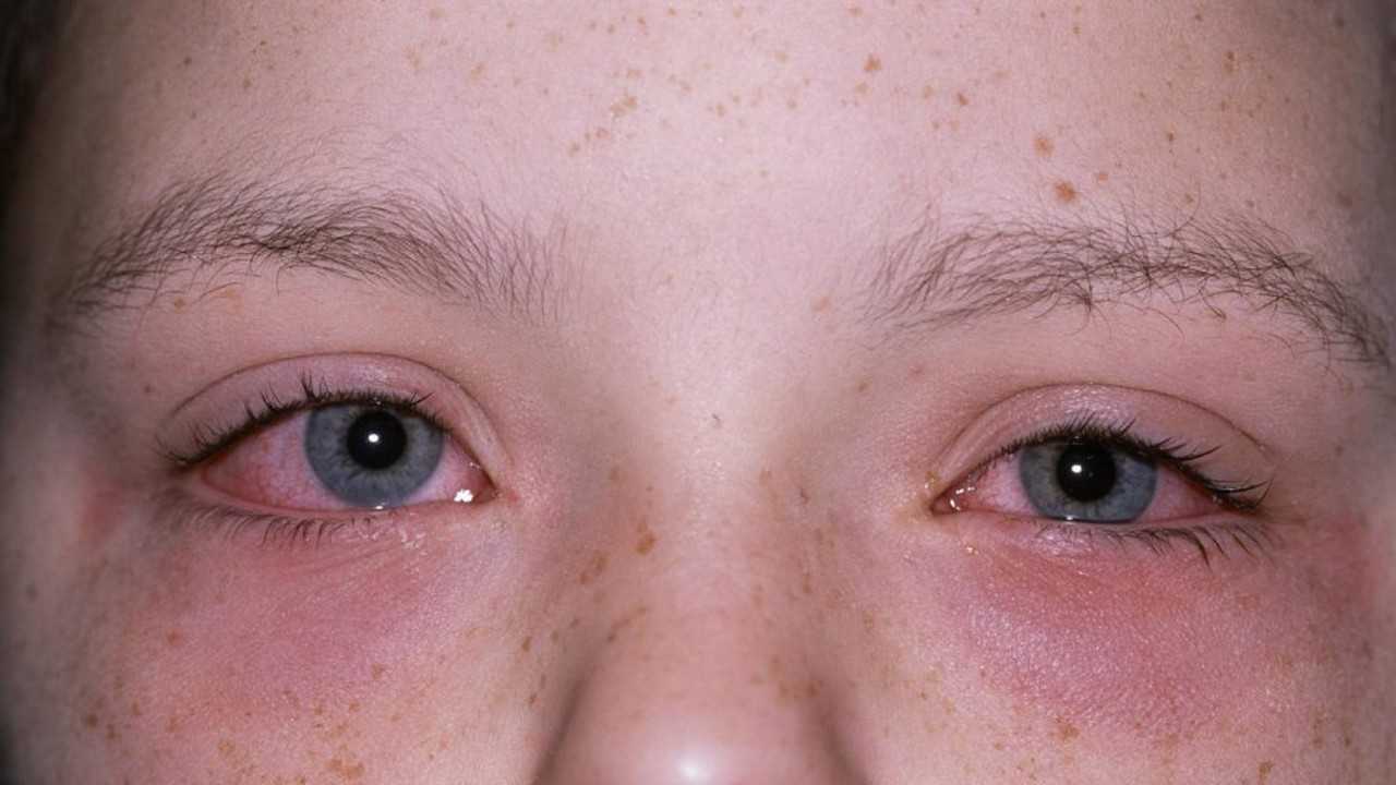 眼睛出现这三个症状可能是患上了红眼病
