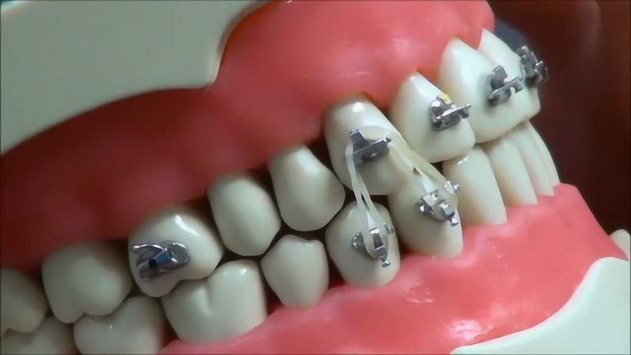 牙齿矫正皮筋图解区别图片