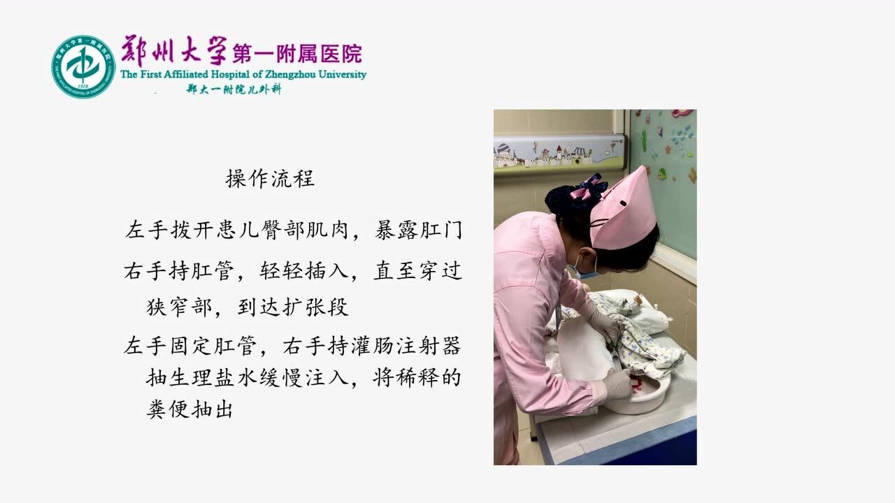清洁回流灌肠法操作演示——郑大一附院小儿外科_高清