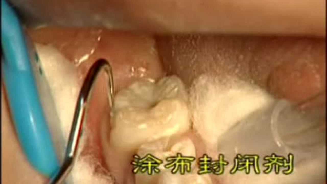 窝沟封闭的基本操作过程_高清