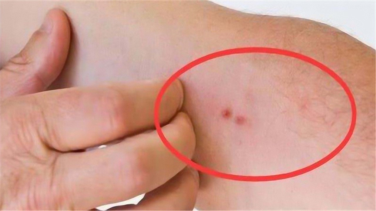 肝癌发生悄无声息,一旦皮肤有4种"标记",别怀疑,去医院!