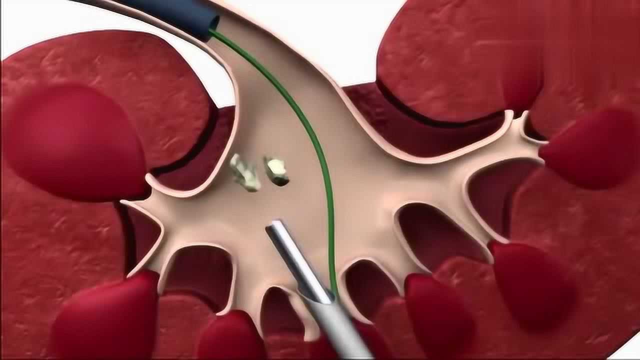 3d动画演示肾结石手术过程,只需一根极细的管子