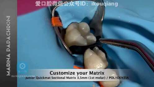 Ⅱ类洞牙体充填修复乳牙