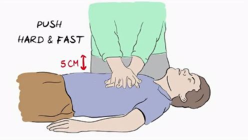 CPR - Simple steps to save a life  拯救人命的简单步骤