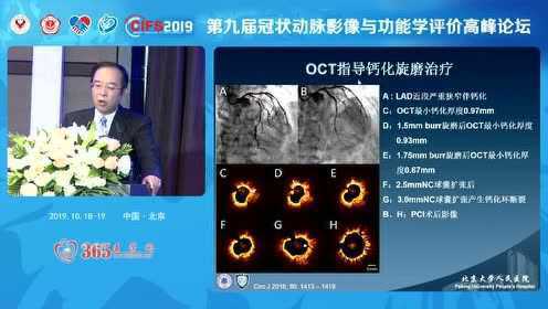 王伟民-腔内影像学精准评估分析钙化病变