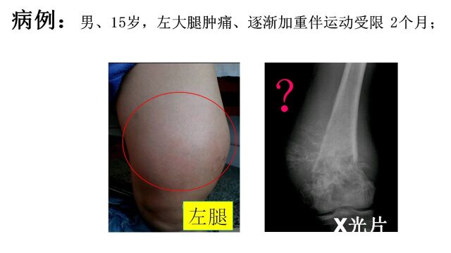 临床医技学影像诊断(精品视频课) 之 骨肉瘤的Ⅹ线诊断