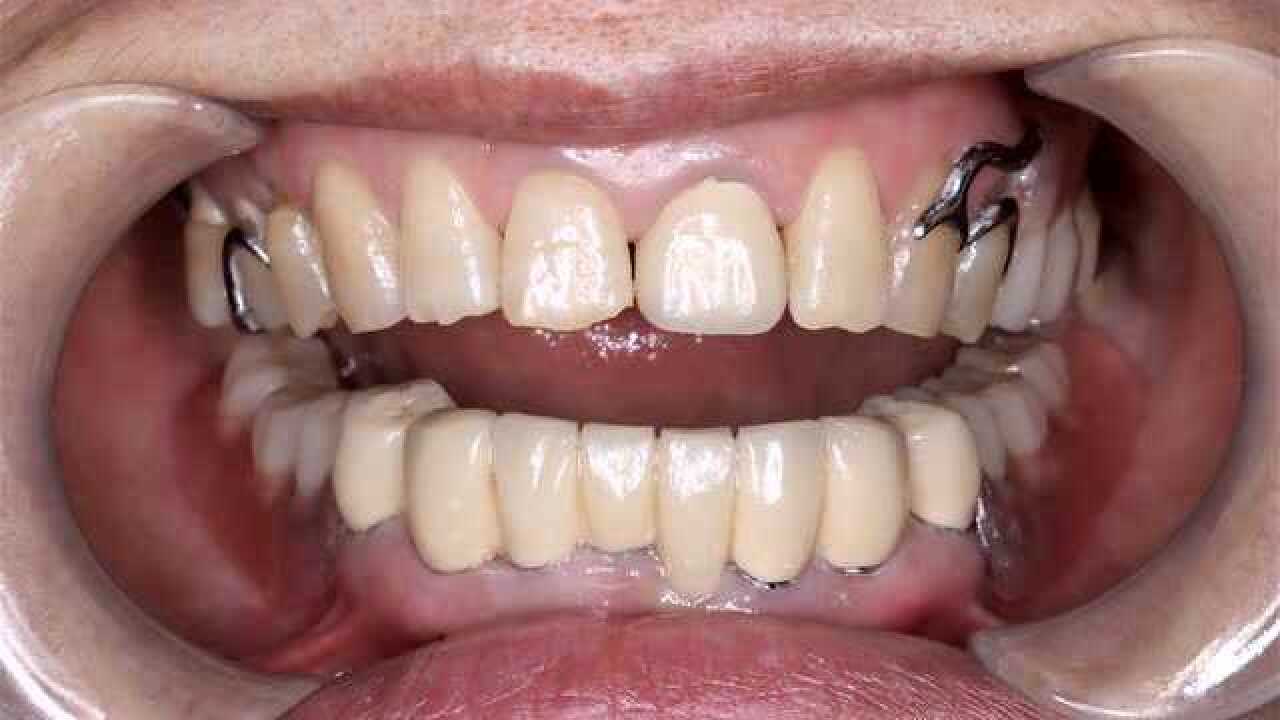 套筒冠修复一例