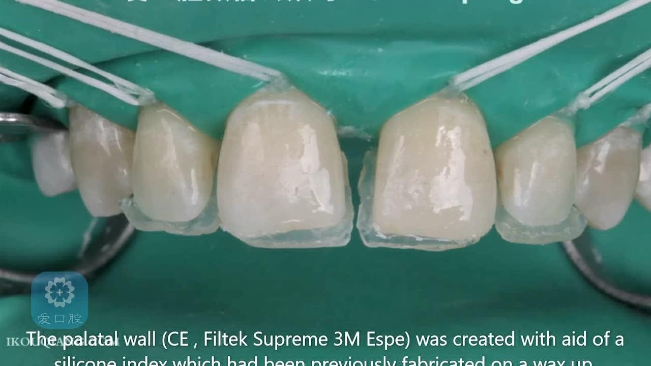 上中切牙4.5mm间隙的美学修复腾讯视频