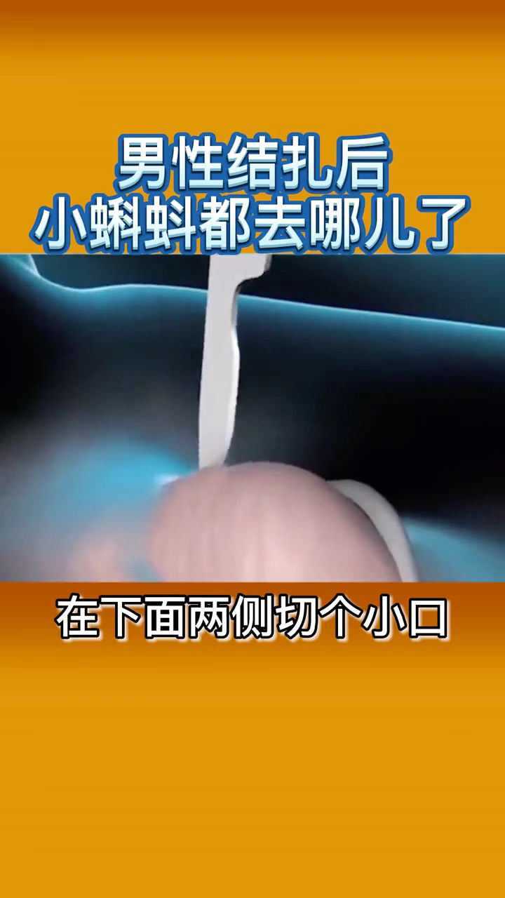 男性结扎后小蝌蚪都哪去了偷偷跑出去玩了吗