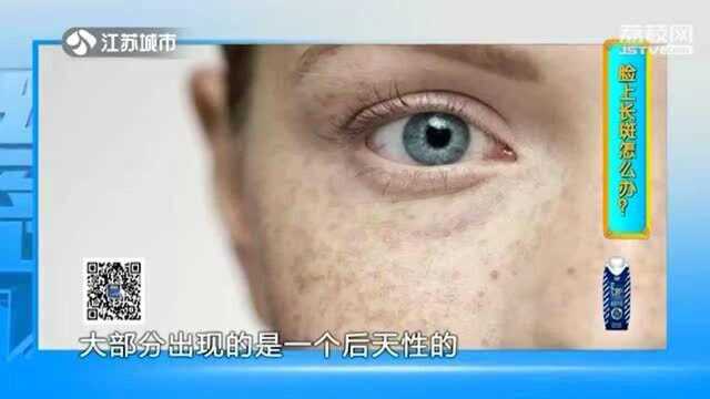 脸上长斑怎么办?色素痣、雀斑、黄褐斑……治疗方法完全不一样