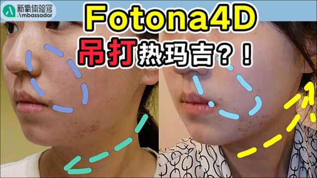 抗衰美白瘦脸一步到位!Fotona4D百人实测