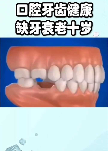 长期缺牙牙槽骨逐渐吸收萎缩面容渐渐凹陷看起来比同龄人老很多