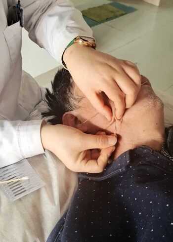 针灸治疗面瘫,口脸歪些吐字不清_腾讯视频