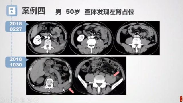 肾细胞癌第八版AJCC分期:影像与临床空军军医大学西京医院任静