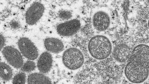世卫：全球已确诊131例猴痘病例