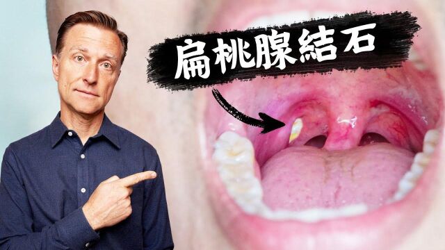 扁桃腺结石原因及预防,自然疗法,柏格医生 Dr Berg