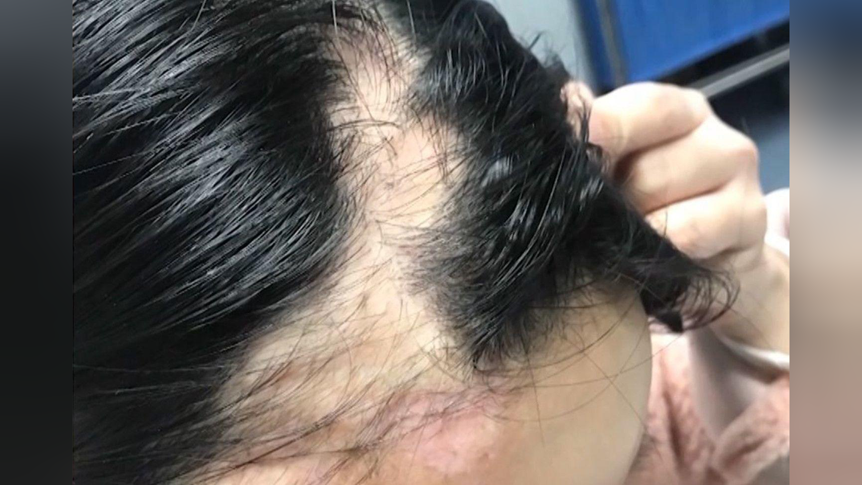 21岁女子打玻尿酸险毁容大把掉头发,医生:玻尿酸注射进了血管