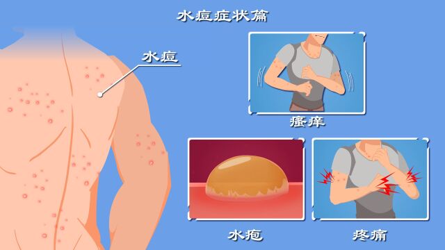 水痘不用管?不慎挠破可致死?水痘每年祸害40万人,都有啥症状?