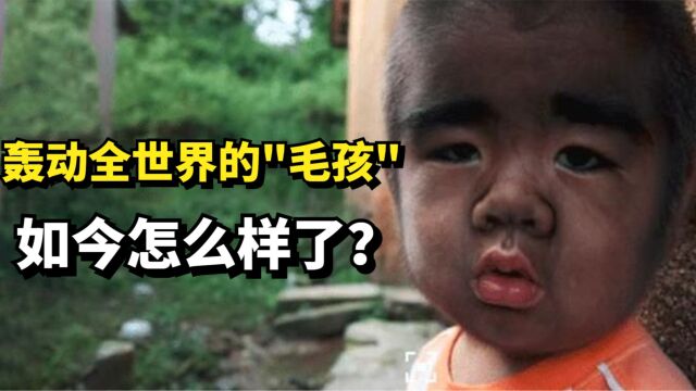 45年前,轰动全世界的“毛孩”于震寰,如今怎么样了?