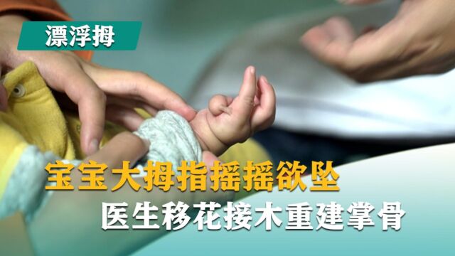 宝宝大拇指悬浮,医生移花接木重建掌骨