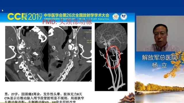 血管肌纤维发育不良:CTA认识之路解放军总医院杨立