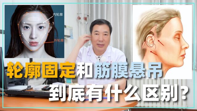 轮廓固定和筋膜悬吊,到底有什么区别?