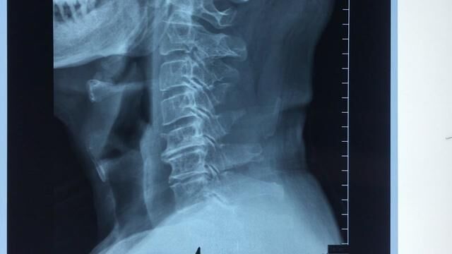 颈椎病X线常见4个表现:生理前凸异常、椎间隙变窄、骨赘增生和项韧带钙化!#颈椎病 #医学科普