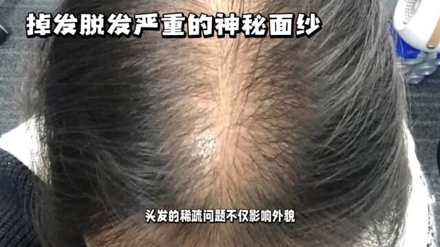 头顶稀疏不堪?揭开掉发脱发严重的神秘面纱,你不能不知!