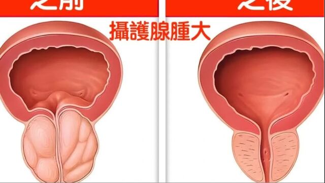 【繁体中文字幕人工翻译】摄护腺肿大(前列腺肿大)每天喝一杯,自然疗法,柏格医生 Dr Berg