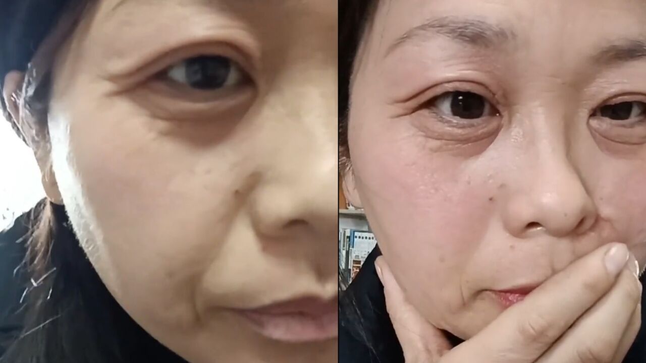 42岁女子20天衰老30多岁,一觉醒来脸垮掉爬满皱纹,晒对比太扎心