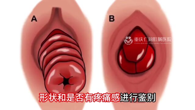 直肠脱垂和痔疮脱出是同一种病?