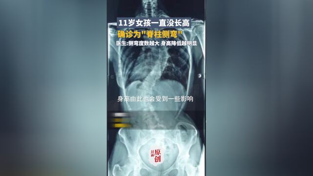 11岁女孩一直没长高,确诊为脊柱侧弯