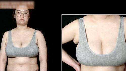 “大胸女”缩胸变自信