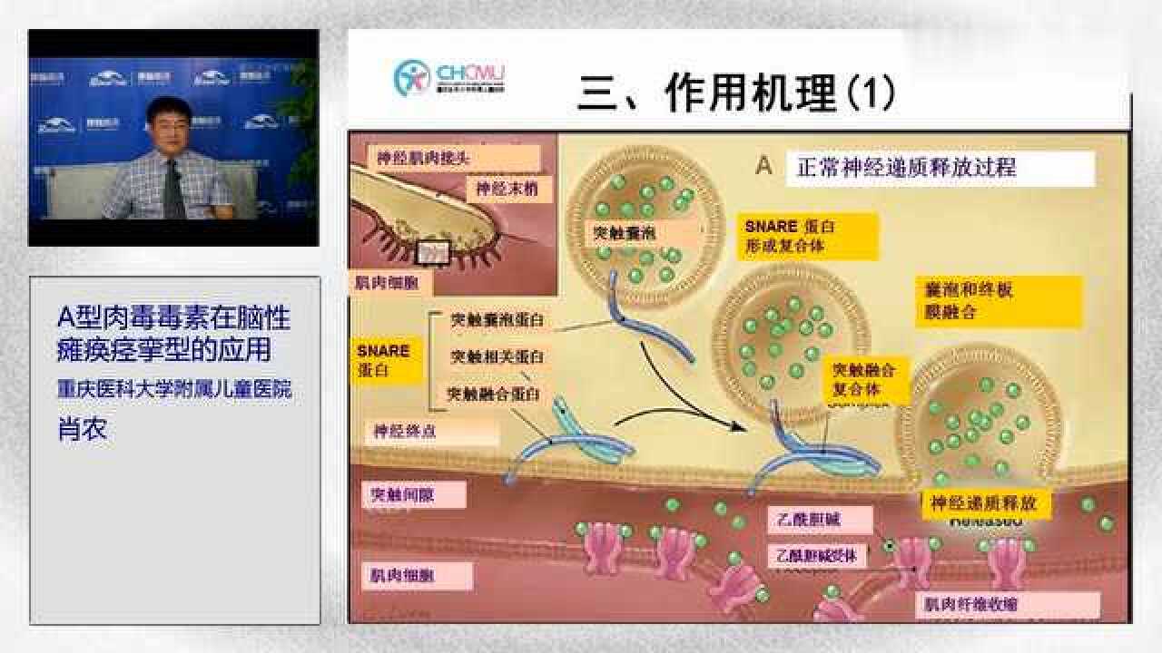 A型肉毒毒素在脑性瘫痪痉挛型的应用之一--肖农_高清1080P在线观看平台_腾讯视频