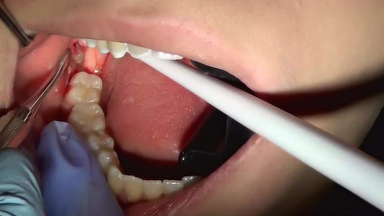 实拍真实拔牙全过程，了解智齿拔除的每个细节！_腾讯视频