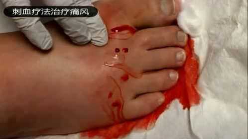 刺血放血疗法治疗痛风脚肿